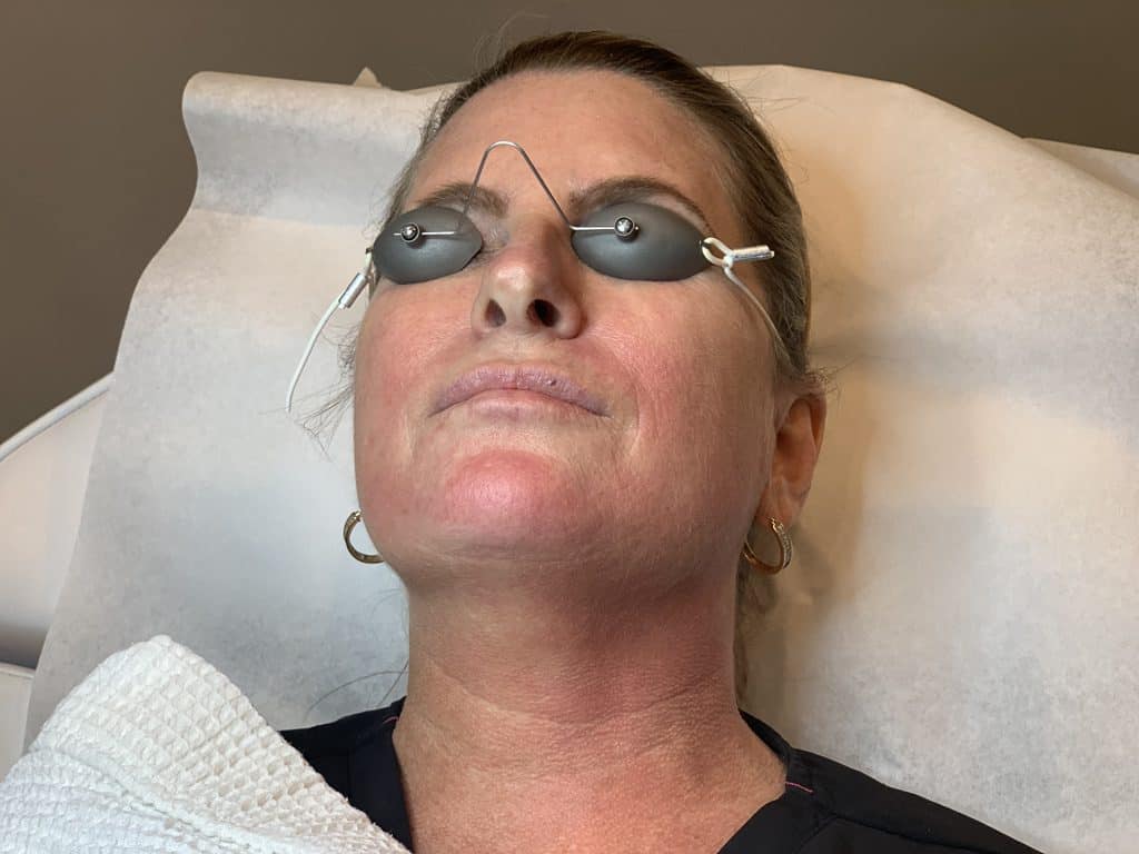 ipl photofacials 3